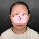 糸リフト / 脂肪吸引（顔） / ジョールファット除去 新宿美容外科ネビュラクリニック BEFORE サムネイル用