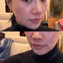 脂肪溶解注射（顔） 上野注入クリニック BEFORE サムネイル用