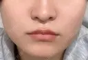 肌ヒアルロン酸注入（たるみ・シワ改善） / ボトックス（エラ・小顔） 東京シンデレラ美容外科 新宿院 BEFORE サムネイル用