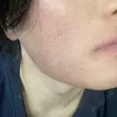 医療脱毛（顔） ZX-CLINIC 梅田院 BEFORE サムネイル用