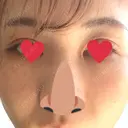 リジュラン Natural Skin Clinic 自由ヶ丘院 BEFORE サムネイル用