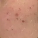 その他（肌） / ポテンツァ ルラ美容クリニック 郡山院 BEFORE サムネイル用