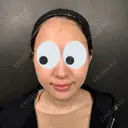 糸リフト / 脂肪吸引（顔） / ジョールファット除去 新宿美容外科ネビュラクリニック BEFORE サムネイル用