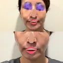 オリジオ PRISM Beauty Clinic 新宿院 BEFORE サムネイル用