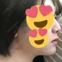 鼻尖形成（切開） / 鼻中隔延長（切開） / 小鼻縮小（切開） / 軟骨移植 / ワシ鼻修正・ハンプ切除 / 鼻尖縮小 カイ整形外科・皮膚科 BEFORE サムネイル用