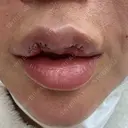 口唇縮小術 千葉美容外科アイビークリニック BEFORE サムネイル用