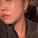 ボトックス（エラ・小顔） 新未来クリニック BEFORE サムネイル用