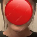 ボトックス（エラ・小顔） / ボトックス（肩） Tokyo Tensei Clinic 新宿院 BEFORE サムネイル用