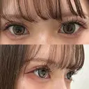 ヒアルロン酸注入（涙袋） 新未来クリニック BEFORE サムネイル用