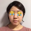 骨切り（あご） / 骨削り（エラ） / 骨削り（頬） / 脂肪吸引（顔） / 脂肪注入（額） / 脂肪溶解注射（顔） View美容整形外科 BEFORE サムネイル用