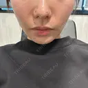 ボトックス（ガミースマイル） / ヒアルロン酸注入（鼻翼基部） ziz CLINIC BEFORE サムネイル用