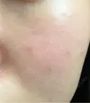 毛穴洗浄（ハイドラフェイシャルなど） / 光治療（フォトフェイシャルなど） Fellez Clinic【フェルズクリニック】 BEFORE サムネイル用