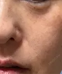 ほくろ・いぼ切除（肌） ルラ美容クリニック 横浜院 BEFORE サムネイル用