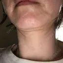 ヒアルロン酸溶解 / インモード Moon Beauty Clinic BEFORE サムネイル用
