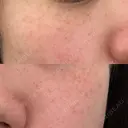 ピーリング（ハリ・ツヤ） / ルメッカ ルラ美容クリニック 札幌本院 BEFORE サムネイル用