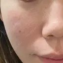 ピーリング（ニキビ・毛穴） / イオン導入 / 赤み除去レーザー RIN BEAUTY CLINIC BEFORE サムネイル用