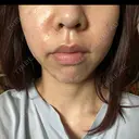 医療脱毛（顔） ダビデクリニック渋谷 BEFORE サムネイル用