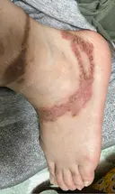 タトゥー除去 アサイクリニック 心斎橋本院 BEFORE サムネイル用