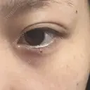 目頭切開 新宿美容外科ネビュラクリニック BEFORE サムネイル用