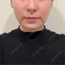 糸リフト ガーデンクリニック 船橋院 BEFORE サムネイル用