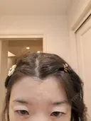 再生医療 A CLINIC（エークリニック） 新宿院 BEFORE サムネイル用