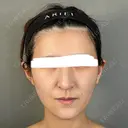脂肪注入（額） / ボトックス（あご） / ヒアルロン酸注入（唇） / 脂肪注入（輪郭） アリエル美容クリニック 大宮院 BEFORE サムネイル用