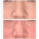 鼻尖形成（切開） / 鼻尖縮小 / ヒアルロン酸注入（鼻） 東京ヒルズクリニック 新宿院 BEFORE サムネイル用
