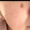 シミ取りレーザー BIJOU CLINIC BEFORE サムネイル用
