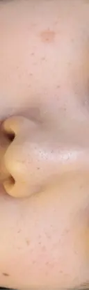 ルメッカ ハナビューティークリニック BEFORE サムネイル用