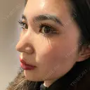 ヒアルロン酸注入（鼻） / ヒアルロン酸注入（鼻翼基部） HAAB×DREAM BEAUTY CLINIC 大阪梅田院 BEFORE サムネイル用