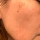 シミ取りレーザー S-Laboクリニック 渋谷院 BEFORE サムネイル用