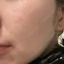 光治療（フォトフェイシャルなど） / ミラノリピール トラスト美容クリニック 銀座院 BEFORE サムネイル用