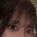 ヒアルロン酸注入（涙袋） サラ美容外科 BEFORE サムネイル用