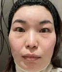 クマ治療 / 下まぶたの脂肪取り 新宿美容外科ネビュラクリニック BEFORE サムネイル用