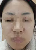 肌育注射（ジュベルックなど） LA MER CLINIC BEFORE サムネイル用