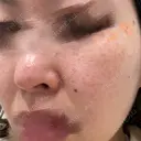 ピコレーザートーニング（美白・かんぱん） / ピコスポット APスキンクリニック銀座 BEFORE サムネイル用