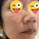 イオン導入 / ピコレーザートーニング（美白・肝斑） ルラ美容クリニック 渋谷本院 BEFORE サムネイル用
