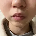 イオン導入 / ルメッカ やさしい美容皮膚科・皮フ科　秋葉原院 BEFORE サムネイル用