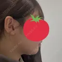 オンダリフト ルラ美容クリニック 福岡本院 BEFORE サムネイル用