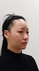 ヒアルロン酸注入（涙袋） / ヒアルロン酸注入（鼻） / ボトックス（あご） / ヒアルロン酸注入（あご） HAAB×DREAM BEAUTY CLINIC 大阪梅田院 BEFORE サムネイル用