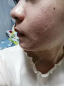 ボトックス（あご） / 肌ヒアルロン酸注入（たるみ・シワ改善） / 美容点滴・美容注射（美肌） / イオン導入 / 美肌レーザー / ニキビ治療 ラミチェ美容整形外科 BEFORE サムネイル用