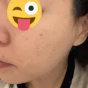 光治療（フォトフェイシャルなど） エイトビューティークリニック 新宿院 BEFORE サムネイル用