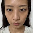 イオン導入 城本クリニック 大阪院 BEFORE サムネイル用