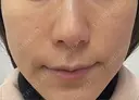 ヒアルロン酸注入（頬） 目白ホワイトクリニック BEFORE サムネイル用