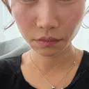 ジャルプロ ウィルビークリニック 銀座院 BEFORE サムネイル用