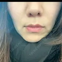 オンダリフト RIVER CLINIC（リバークリニック） BEFORE サムネイル用