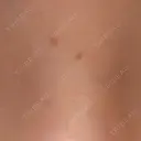 ほくろ・いぼ切除（肌） S-Laboクリニック 渋谷院 BEFORE サムネイル用