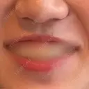 ボトックス（ガミースマイル） ちぐさ内科クリニック 覚王山 BEFORE サムネイル用