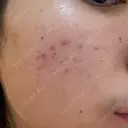 フラクショナルレーザー（毛穴・ニキビ跡） しらゆりメディカルクリニック （旧しらゆりビューティークリニック） BEFORE サムネイル用