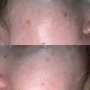 光治療（フォトフェイシャルなど） しんゆり美容健康クリニック BEFORE サムネイル用